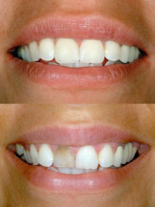 Veneers Before & After | Leisure Dental