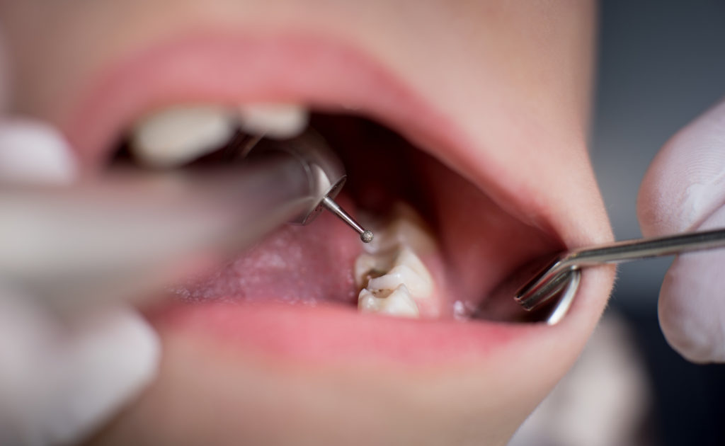 Cavities & Fillings | Leisure Dental