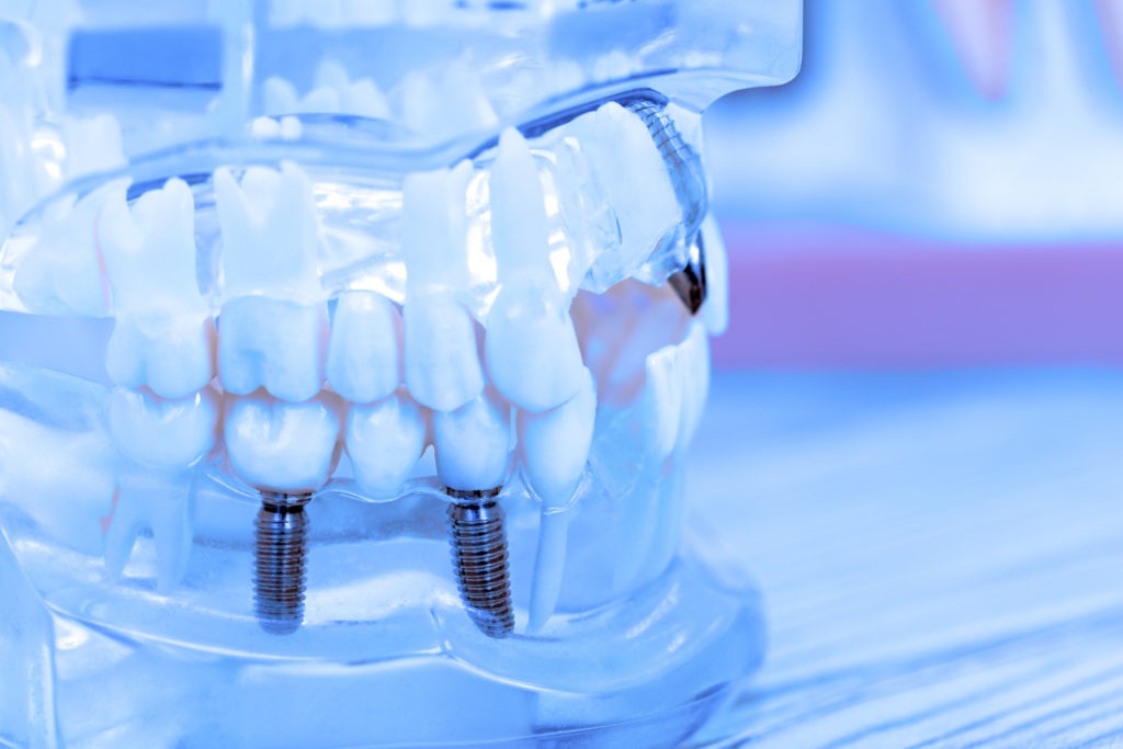 Dental Implants Norfolk VA | Leisure Dental Dental Implants Norfolk VA | Leisure Dental
